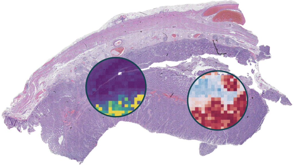 Histopathology slide with AI-based highlights of relevance and contribution for positive and negative predictions.
