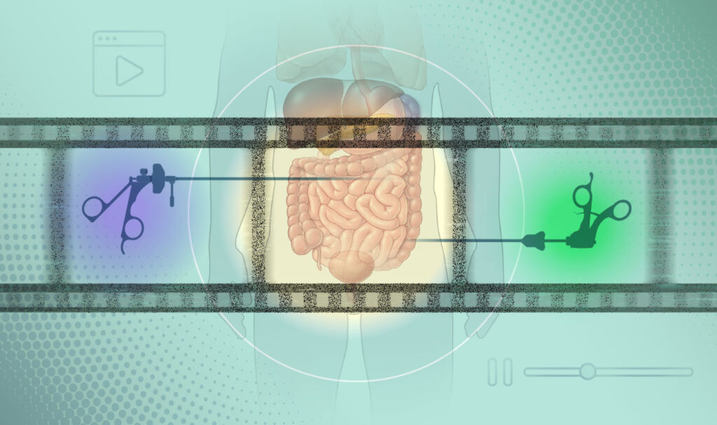 Graphic showing surgical tools, a human colon and a film strip